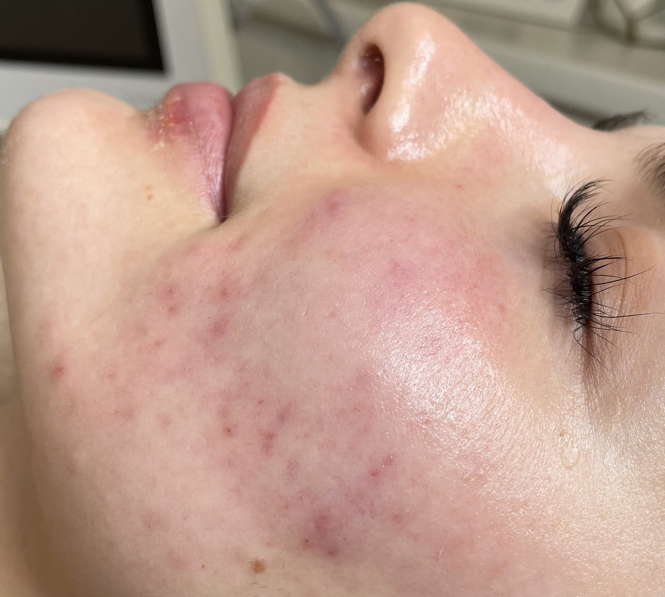 PRODERM TDA 护理后